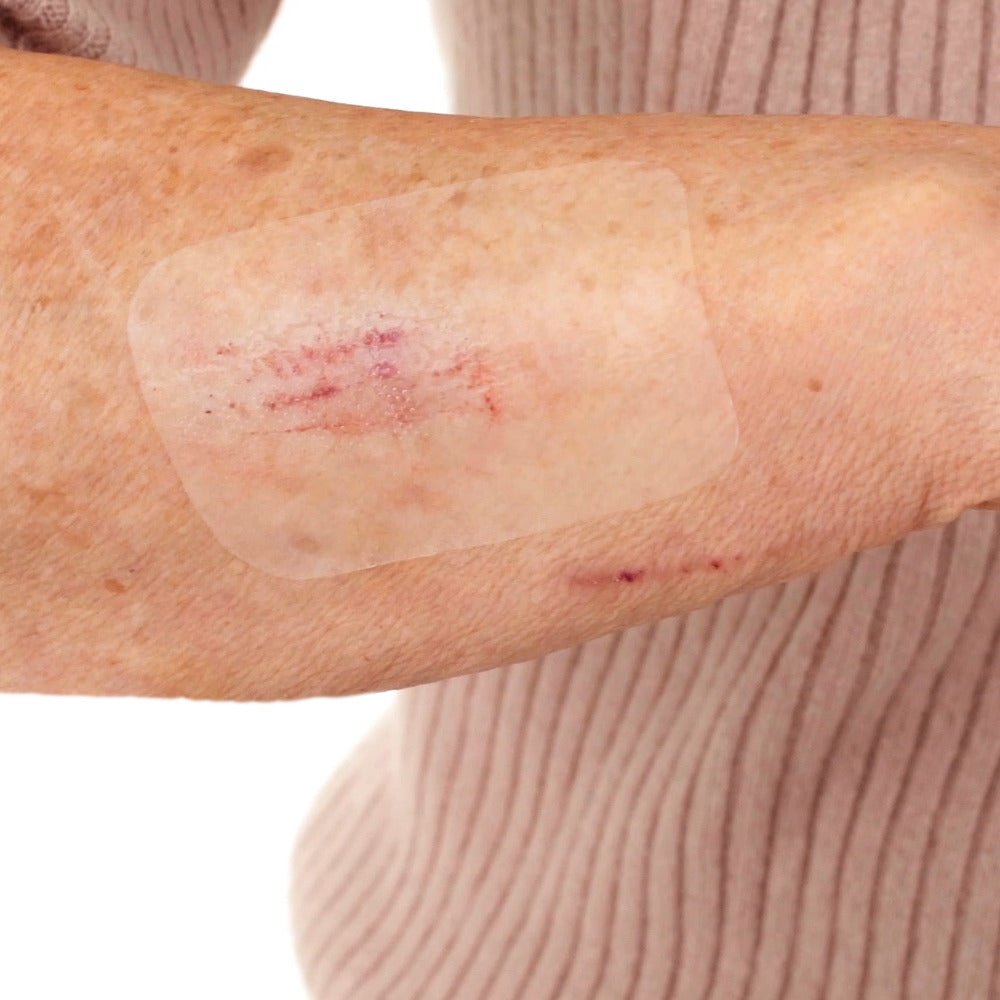 Leukomed T skin sensitive, αποστειρωμένος διαφανής επίδεσμος – σε χρήση