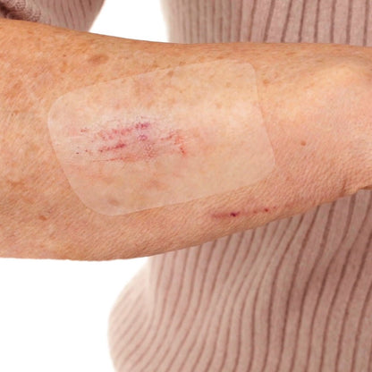 Leukomed T skin sensitive, αποστειρωμένος διαφανής επίδεσμος – σε χρήση